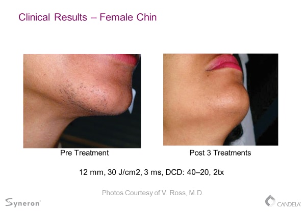 laser-hair-removal-before-and-after-sante-1