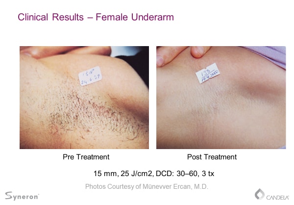 laser-hair-removal-before-and-after-sante-4